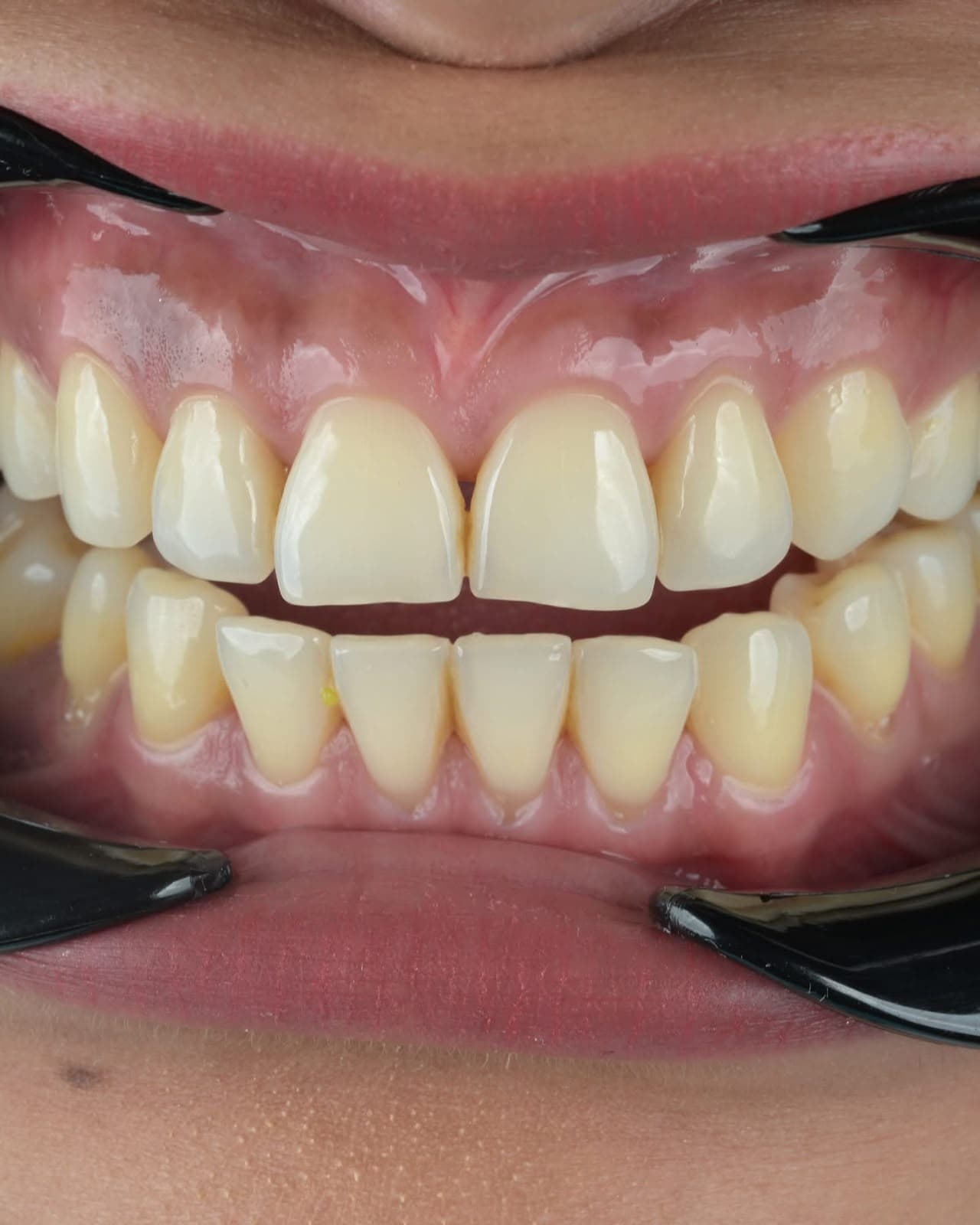 Before treatment