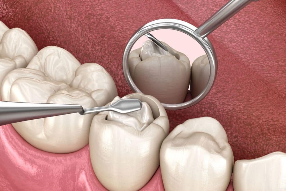 Fillings & Restorations