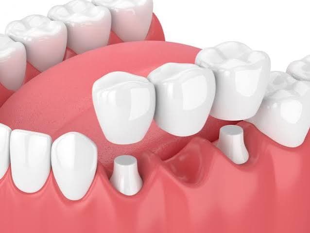 Crowns, Bridges & Dentures