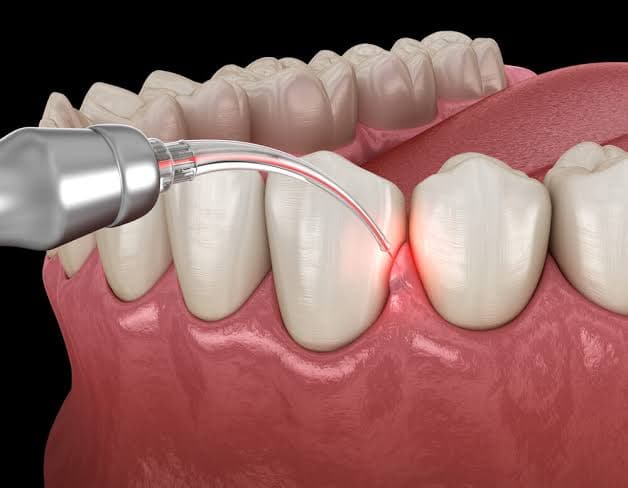 Gum Treatment