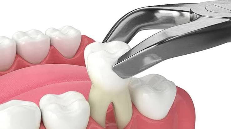 Oral Surgery & Extractions
